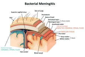 Read more about the article What is bacterial meningitis and how to avoid it?
