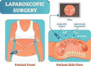 Read more about the article Laparoscopy: Reasons, Risks, and Benefits