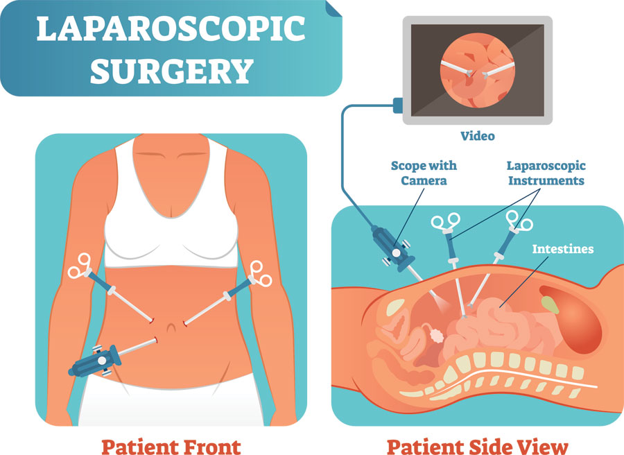 You are currently viewing Laparoscopy: Reasons, Risks, and Benefits